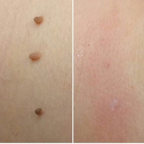 TagAway - Fri från hudflikar på nolltid