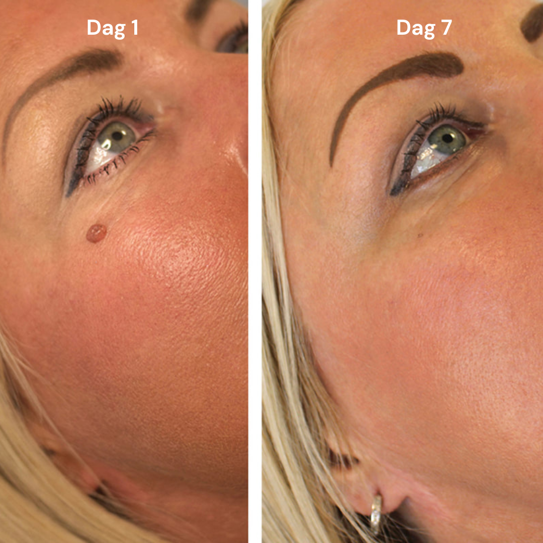 TagAway - Fri från hudflikar på nolltid