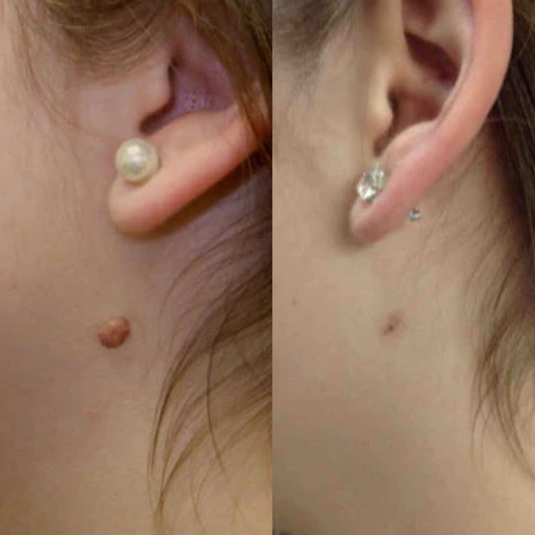 TagAway - Fri från hudflikar på nolltid